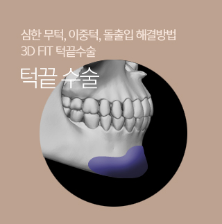 턱끝수술