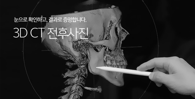 3D CT 전후사진